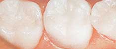 Cerec-nachher